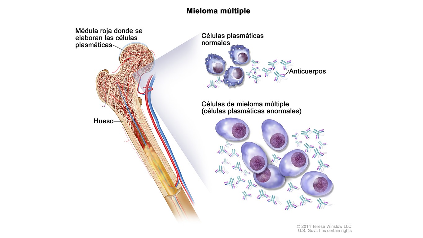 Multiple Myeloma Diagram Spanish Diagrama que muestra las células plasmáticas normales y las células de mieloma múltiple, o células plasmáticas anormales, dentro de la médula ósea.