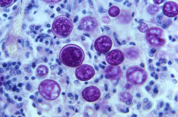 Coccidioides immitis Under a magnification of 500X, this photomicrograph of a periodic acid–Schiff (PAS)-stained lymph node tissue sample, revealed the presence of a number of Coccidioides immitis (the fungus that causes Valley fever) spherules in various stages of development.