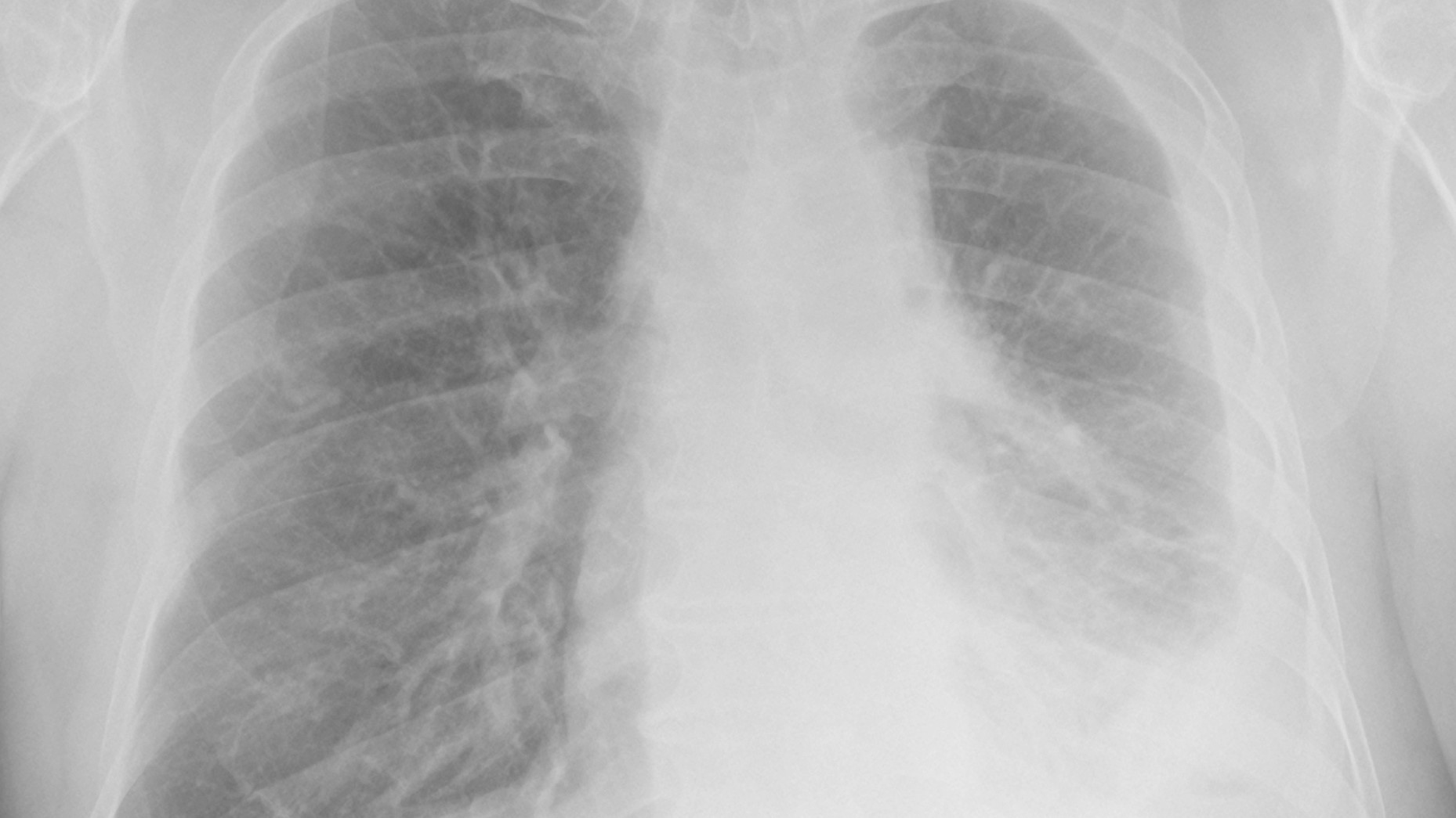Chest X-Ray - Pneumo Image 2 Chest x-ray of lungs with pneumoconiosis.