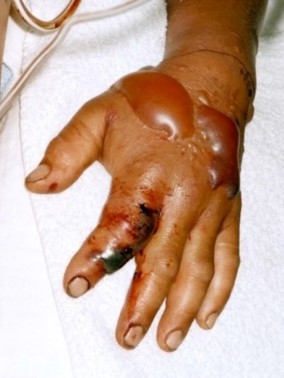 Snakebitten hand Blistered hand from a snake bite to the index finger.