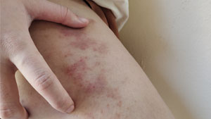Skin Exposure skin reaction showing rash hives allergy and inflammation. The skin has scars and dark spots on the leg of a women.
