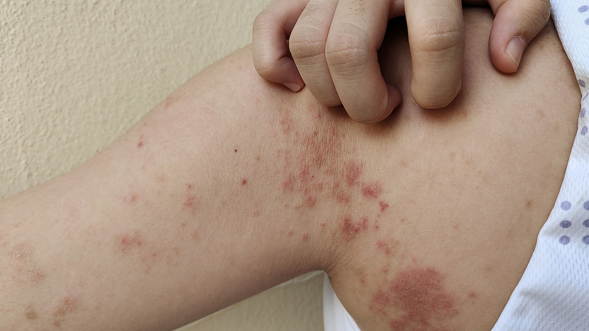 Rash on arm Chronic dermatitis, rash, hives and itchy skin from allergy on the back of a woman's arm