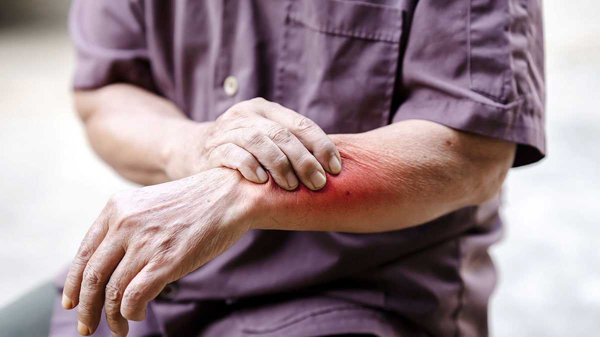 Skin rash Image of a man holdng his arm that has a red skin rash