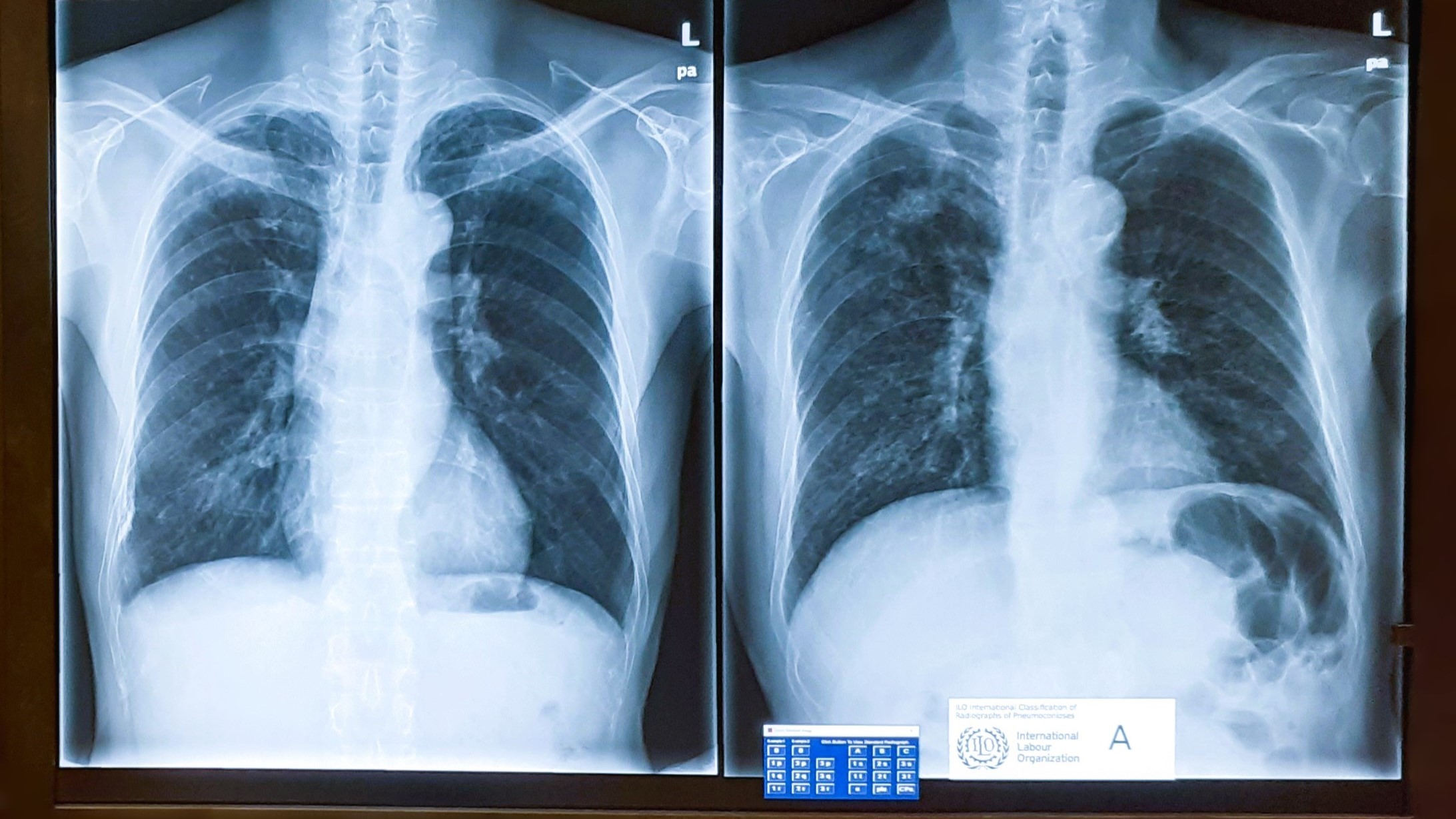 BViewer workstation NIOSH BViewer workstation showing two chest x-rays.