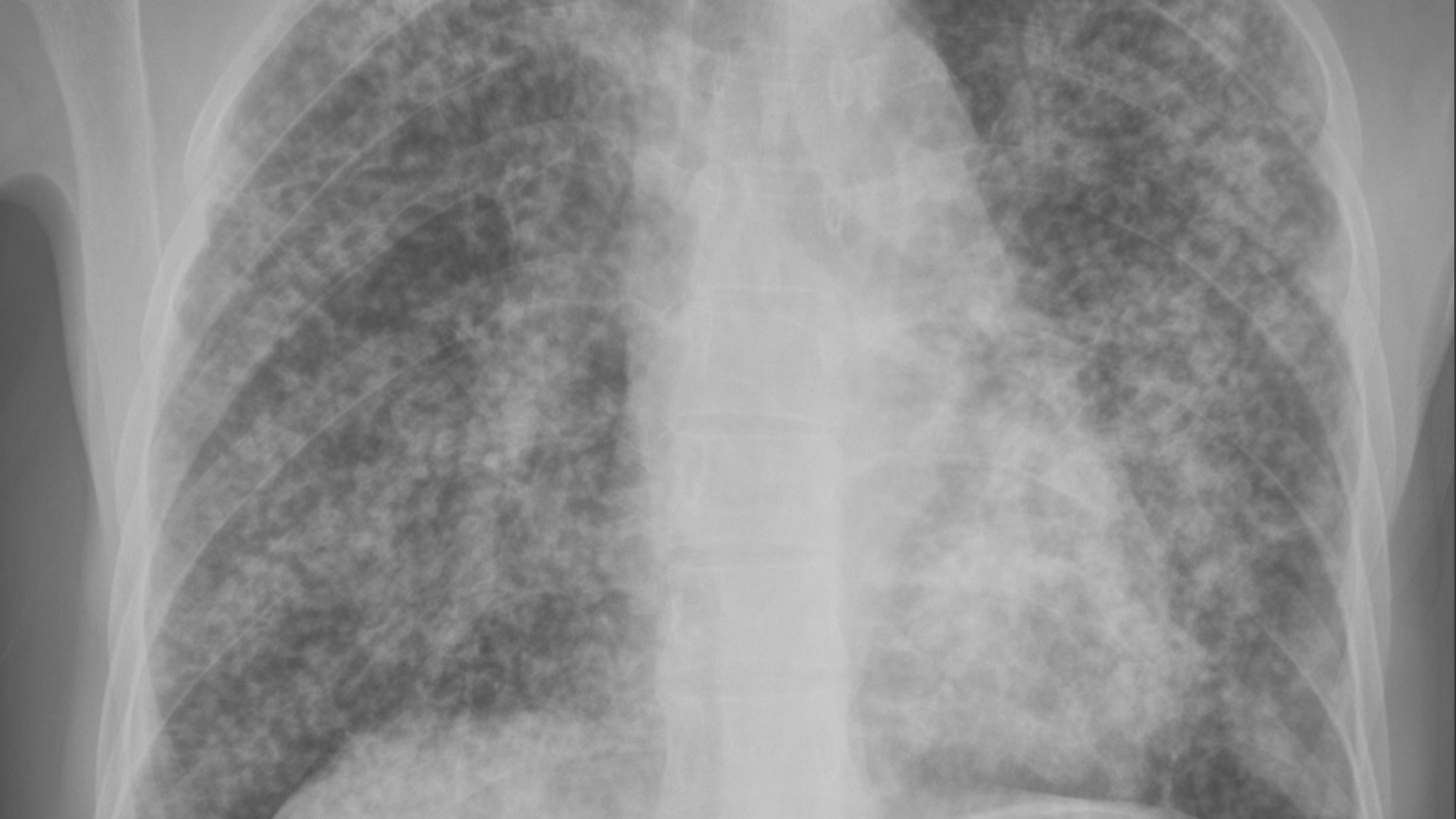 — title missing — An x-ray of a lung with disease.