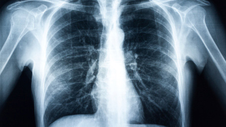 — title missing — A chest x-ray.