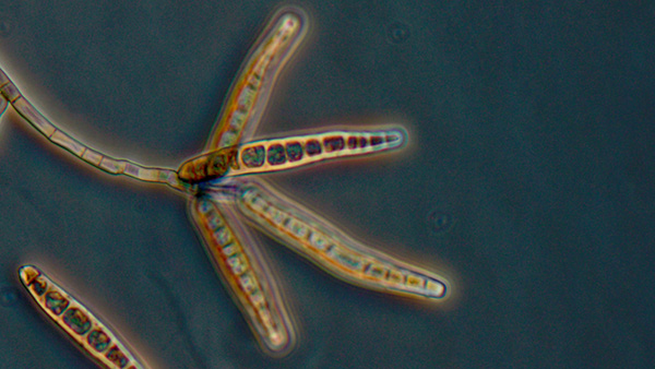 meningitis Microscopic image of meningitis