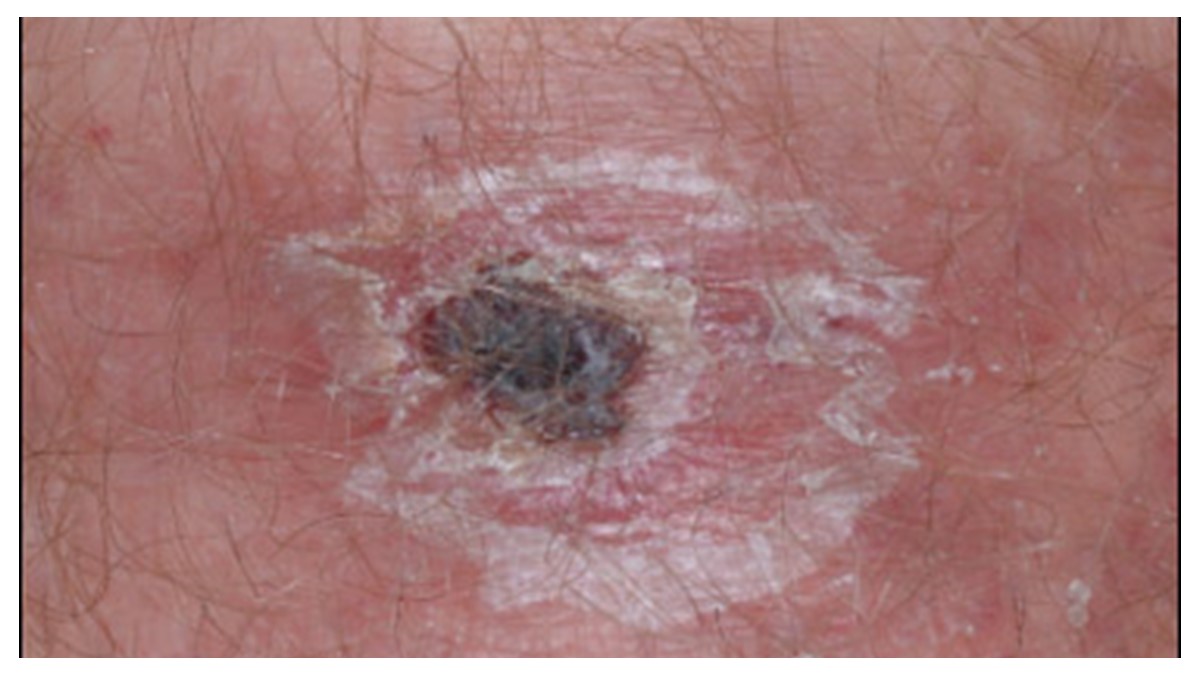 Eschar Eschar at site of tick or mite bite