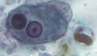 ehistolytica Entamoeba histolytica