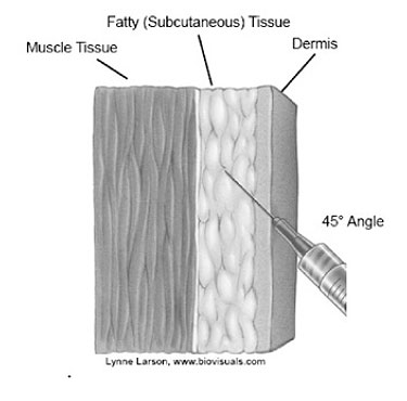 skin Image of needle entering fatty (subcutaneous) tissue, at 45-degree angle, through the dermis, stopping before the muscle tissue.
