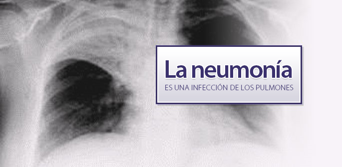 Radiografía de los pulmones con neumonía