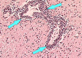 cuffing_100x.jpg Microscope image of perivascular cuffing and inflamation around a blood vessel (Magnified 100x)