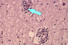 cuffing_200x.jpg Microscope image of perivascular cuffing and inflamation around a blood vessel (Magnified 200x)