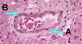no_inflammatory_200x.jpg Microscope image of blood vessel without inflammatory cells (Magnified 200x)