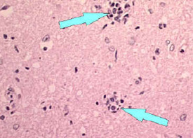 nodules.jpg Microscope image of babes nodules