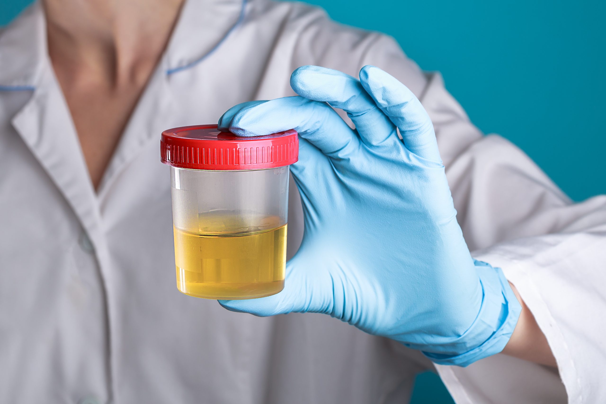 Urine Radionuclide Screening Lab personnel holding a urine specimen.