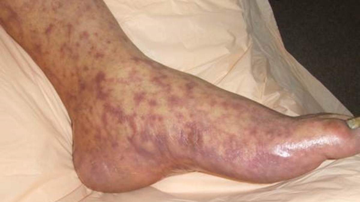 rmsffoot.jpg Rocky Mountain Spotted Fever rash on foot.