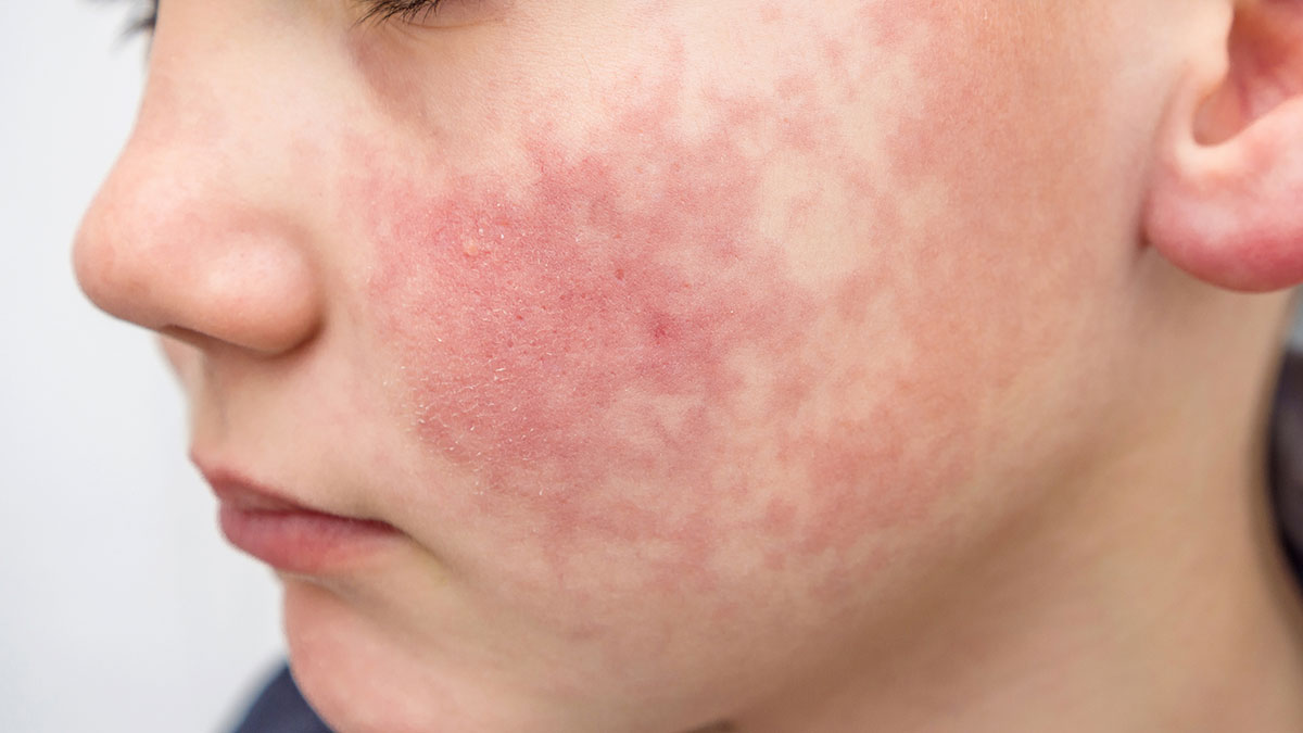 Child with rubella rash on face Child with rubella rash on face.