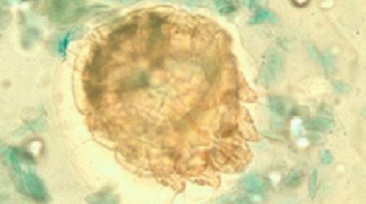 — title missing — Scabies