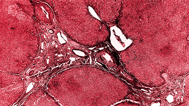 Schistosomiasis in liver tissue Schistosomiasis in liver tissue