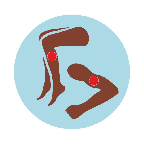 -- title missing -- Illustration of blood clots in arm and leg.