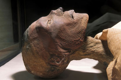 Smallpox Mummy A mummy head