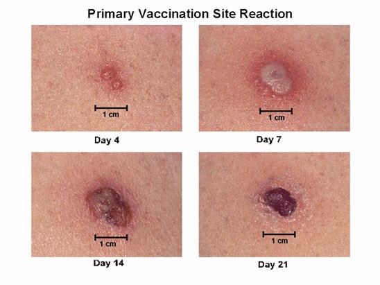 Vaccination Site Reaction Four photos showing the progression of normal smallpox vaccination site reaction.