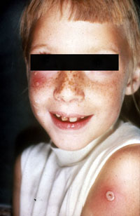 Smallpox Adverse Reaction Accidental Autoinoculation of Cheek A child with a red rash on his cheek and a white pustule on his arm