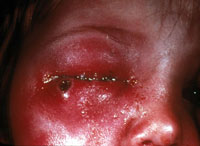 Smallpox Adverse Reaction Accidental Autoinoculation of Eyelid A very swollen and red child's eye
