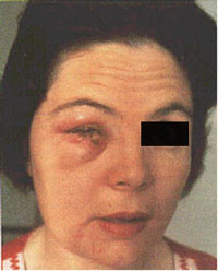 Smallpox Adverse Reaction Accidental Autoinoculation of Lower Eyelid A woman's face with a swollen and red eye