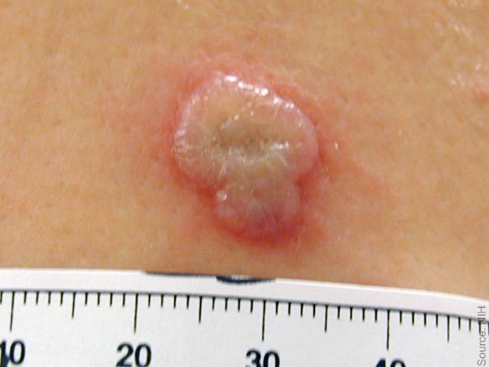 Smallpox Take Reaction “Bi-lobed” Normal Pustule A raised whitish pustule with red edges on light skin