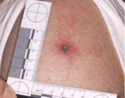 Smallpox Vaccine Take Reaction Central Lesion 1 Centimeter An upper arm with a lesion from smallpox vaccination