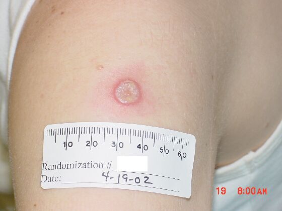 Comparison Reaction Day 10 - First Time Vaccinee An upper arm with a grey lesion and red ring around it
