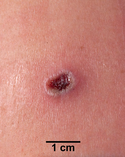 Comparison Reactions Day 10 - First Time Vaccinee An arm with a dark red lesion