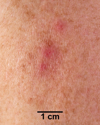 Comparison Reactions Day 10 - Revaccinnee 1 An arm with a small rash