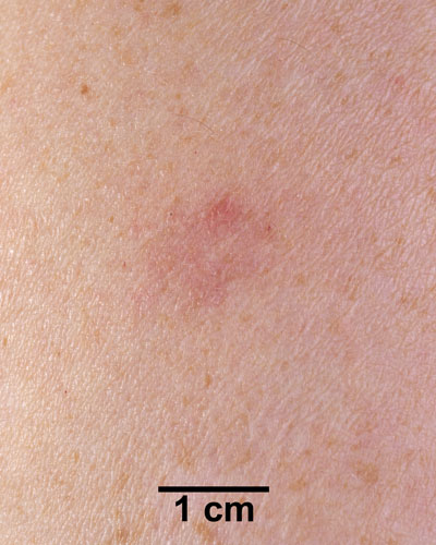 Comparison Reactions Day 10 - Revaccinnee 2 An arm with a very slight rash