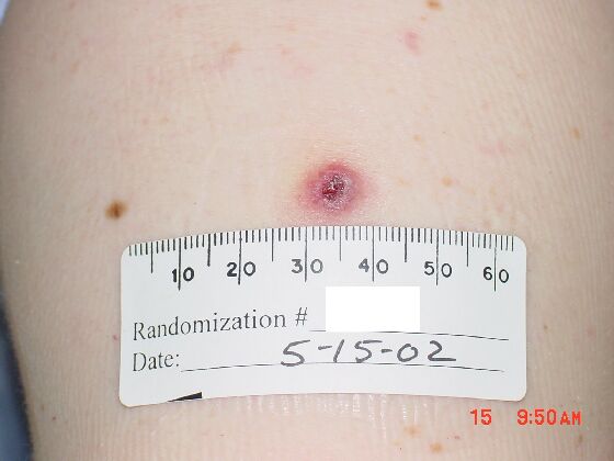 Comparison Reactions Day 10 - Revaccinnee An upper arm with a red lesion and dark red center