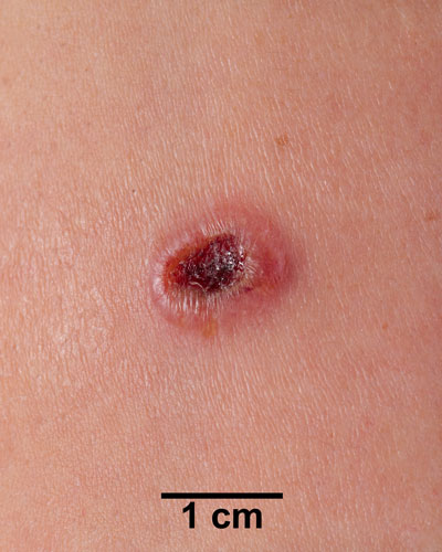 Comparison Reactions Day 14 - First Time Vaccinee An arm with a dark red lesion