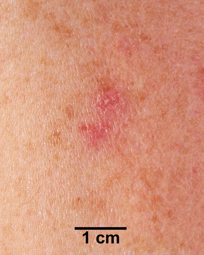 Comparison Reactions Day 14 - Revaccinnee 1 An arm with a slight red rash