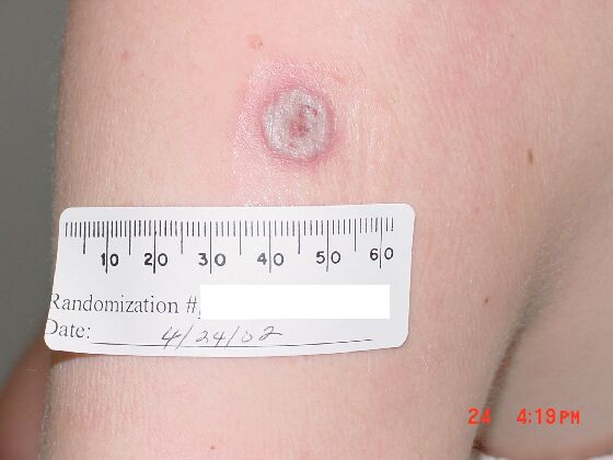 Comparison Reactions Day 15 - First Time Vaccinee An upper arm with a grey lesion surrounded by a red ring, with a red center