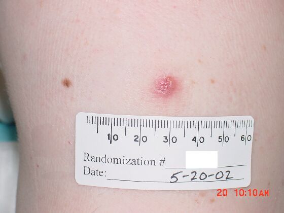 Comparison Reactions Day 15 - Revaccinnee An upper arm with a red lesion