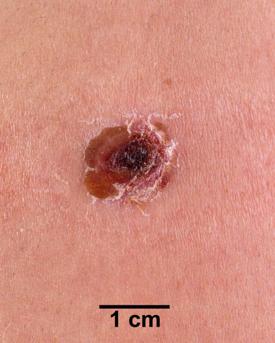 Comparison Reactions Day 18 - First Time Vaccinee An arm with a crusty red scab