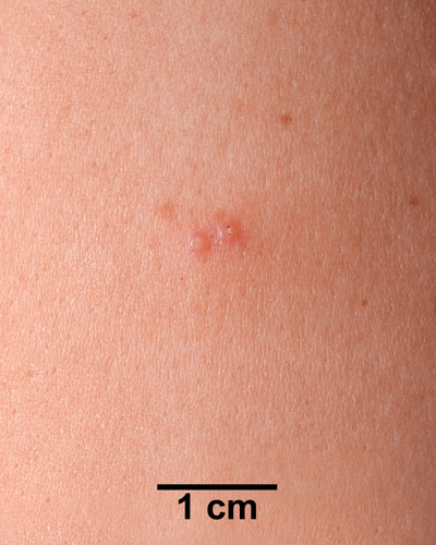 Comparison Reactions Day 3 - First Time Vaccinee An arm with a slight lesion