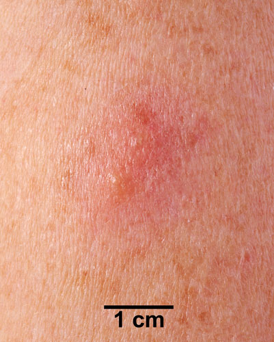 Comparison Reactions Day 3 - Revaccinnee 1 An arm with a small rash