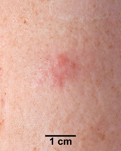 Comparison Reactions Day 3 - Revaccinnee 2 An arm with a small rash