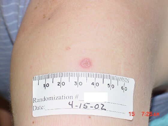 Comparison Reactions Day 6 - First Time Vaccinee An upper arm with a red lesion