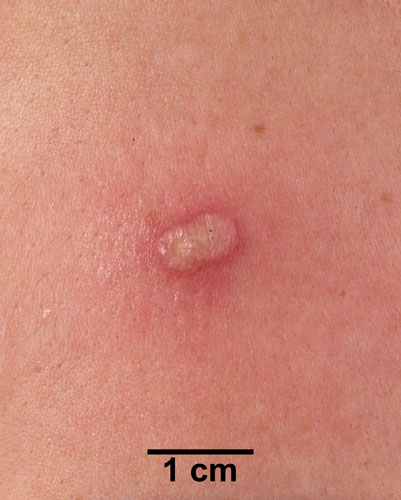 Comparison Reactions Day 7 - First Time Vaccinee An arm with a whitish pustule