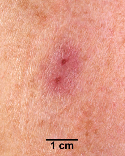 Comparison Reactions Day 7 - Revaccinnee 1 An arm with a red rash