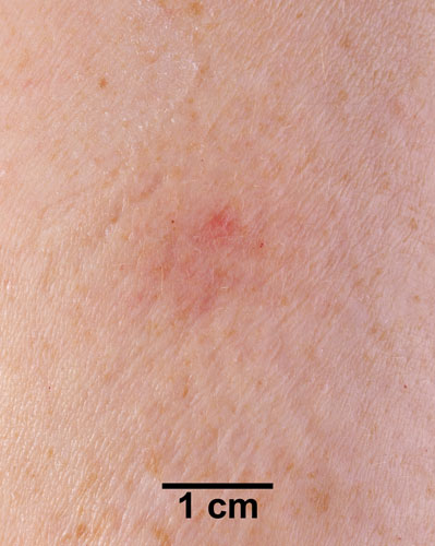 Comparison Reactions Day 7 - Revaccinnee 2 An arm with a very slight rash