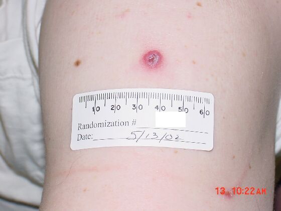 Comparision Reactions Day 8 - Revaccinee An upper arm with a red lesion and grey center